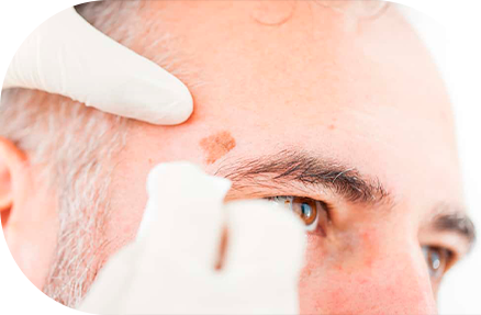 Exame dermatológico com dermatoscópio